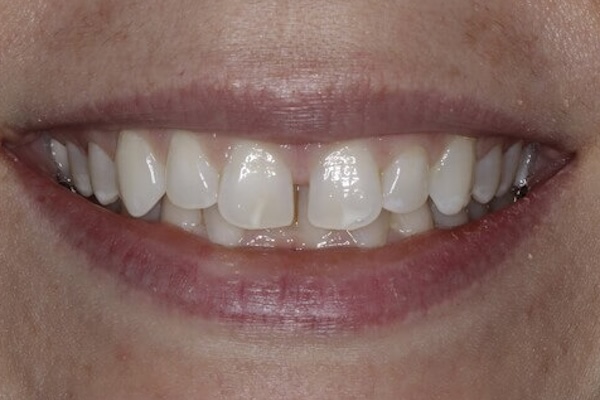 Before