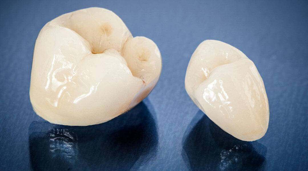 How CEREC SameDay Crowns Save Time and Restore Smiles Faster