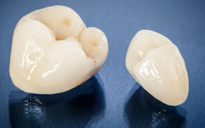 How CEREC SameDay Crowns Save Time and Restore Smiles Faster