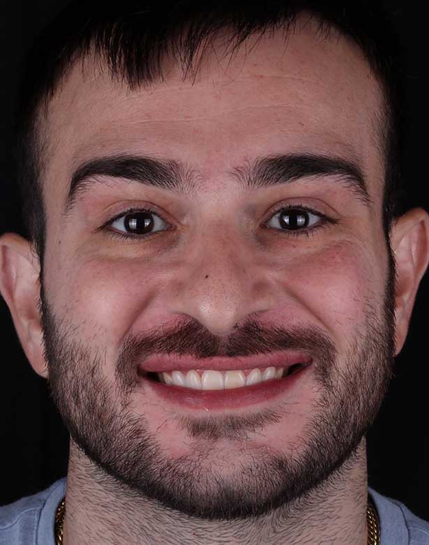 jake-gargiulo-before-after Elena