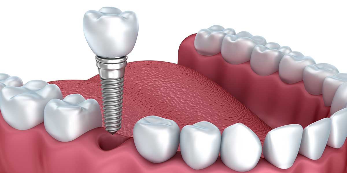 Single Dental Implants in Massapequa