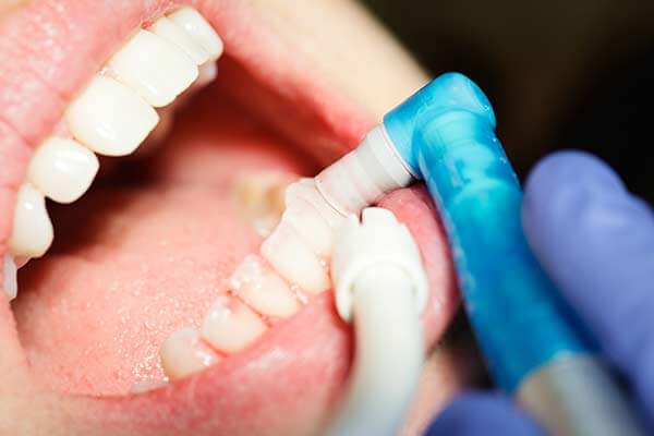 Dental Cleaning