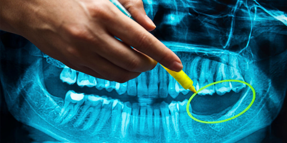 Benefits of Dental Implants in Massapequa