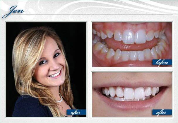 receding gums smile gallery massapequa NY greater long island dental