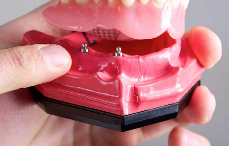 Mini Dental Implants in Massapequa